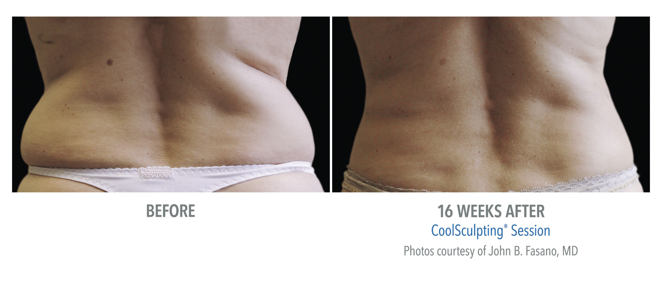 CoolSculpting targets, freezes stubborn body fat 3